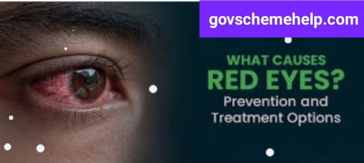 Eye Flu Conjunctivitis